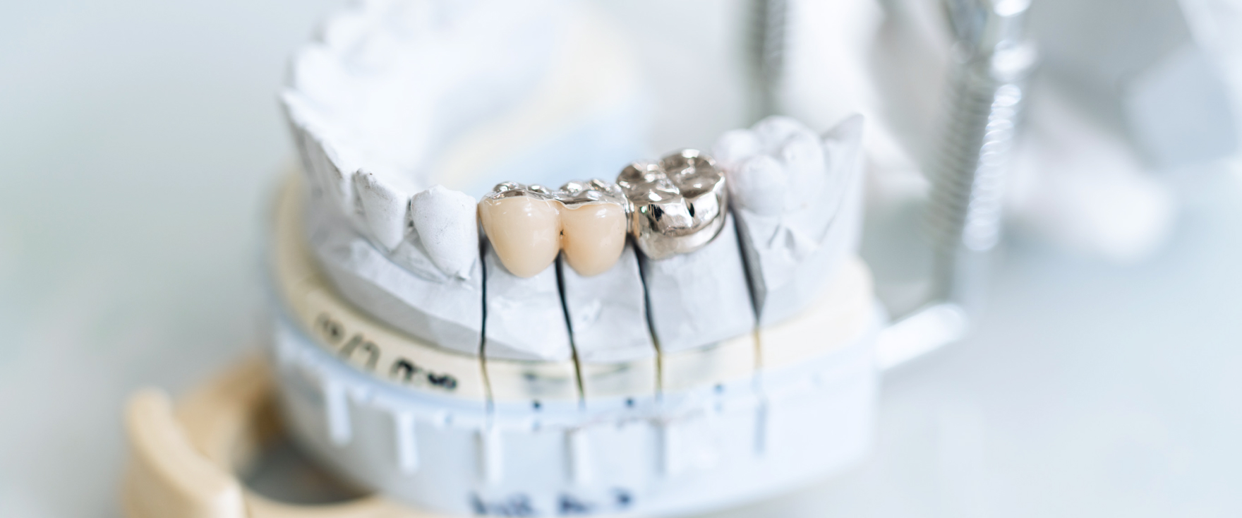 つめ物や被せ物